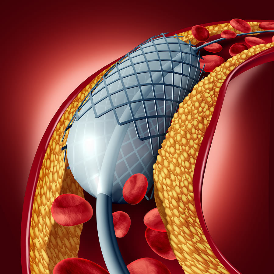 Cardiac Catheterization