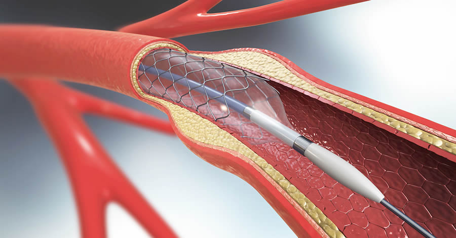 Carotid Angioplasty