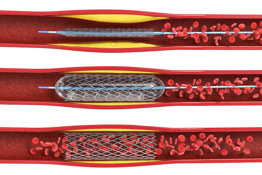 Coronary Stents