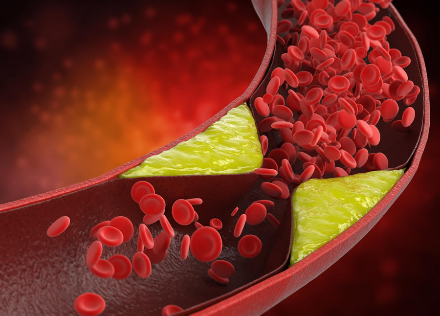 Coronary Artery Disease